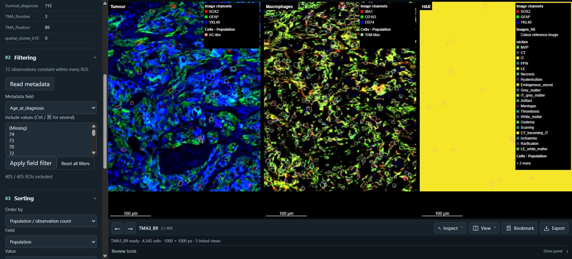 Scroll up and click on "Age_at_diagnosis" - we can filter ROIs by specific groups.